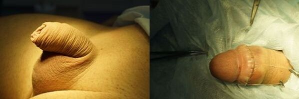առնանդամի ընդլայնման վիրահատությունից առաջ և հետո