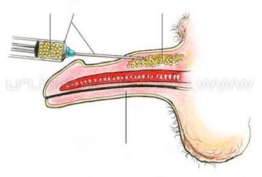 առնանդամի ներարկման ընդլայնում